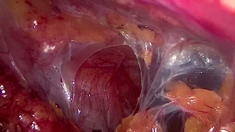 A laparoscopic stepwise approach to Hartmann’s reversal