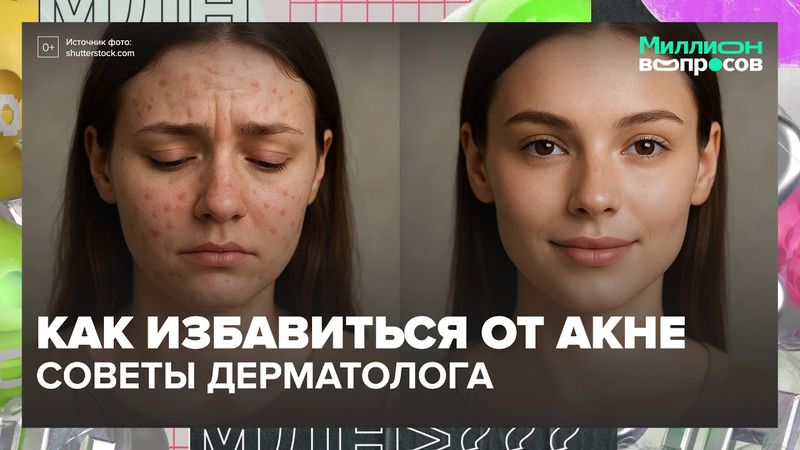 Как избавиться от акне, пигментации и черных точек | Советы дерматолога Москва 24