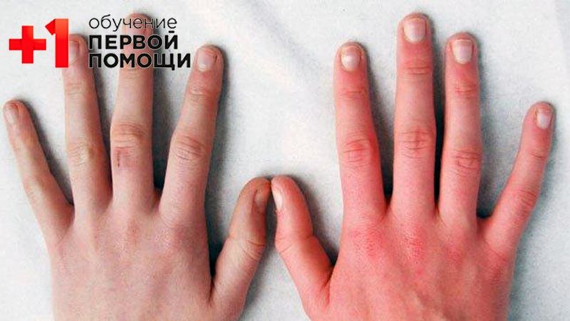 Отморожение || Первая помощь при отморожении || Проект+1