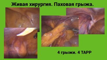 Живая хирургия. Паховая грыжа. 4 грыжи. 4 TAPP