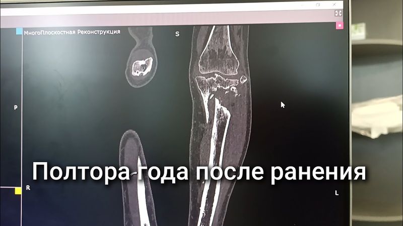 Полтора года после ранения