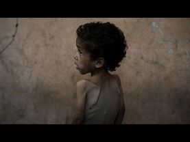 Gaza's children are starving. What does malnutrition do to the human body?