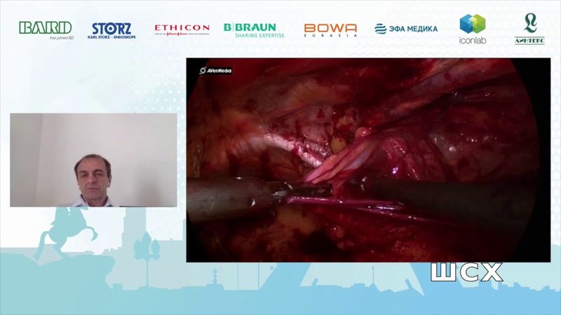 А. Аболмасов E-TEP пластика при паховой грыже