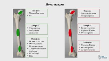 Диагностика опухолей костей  современный взгляд морфолога. Рогожин Д.В.