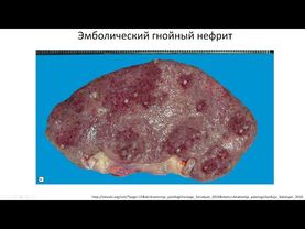 01-10 Экссудативное воспаление