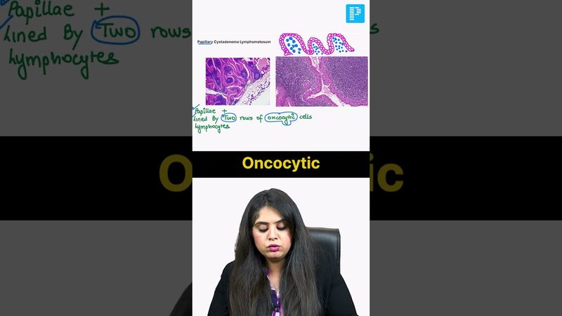 Salivary Gland Pathology by Dr. Preeti Sharma