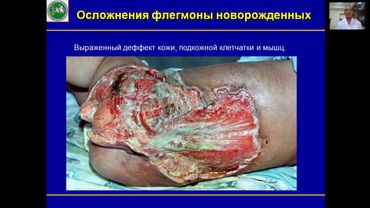 Гнойно воспалительные заболевания кожи и подкожной клетчатки у детей часть 1