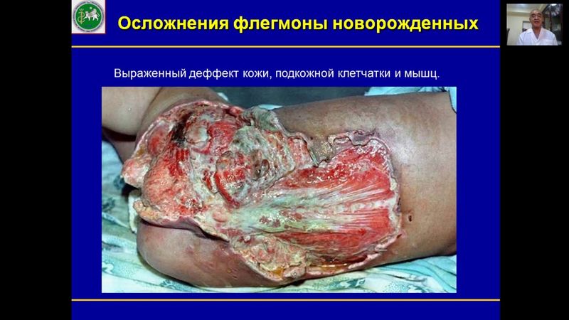 Гнойно воспалительные заболевания кожи и подкожной клетчатки у детей часть 1