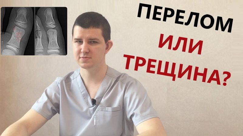 Перелом или трещина? | Доктор Драганик