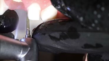 СТОМБУДНИ#58 Препарирование под мостовидую конструкцию