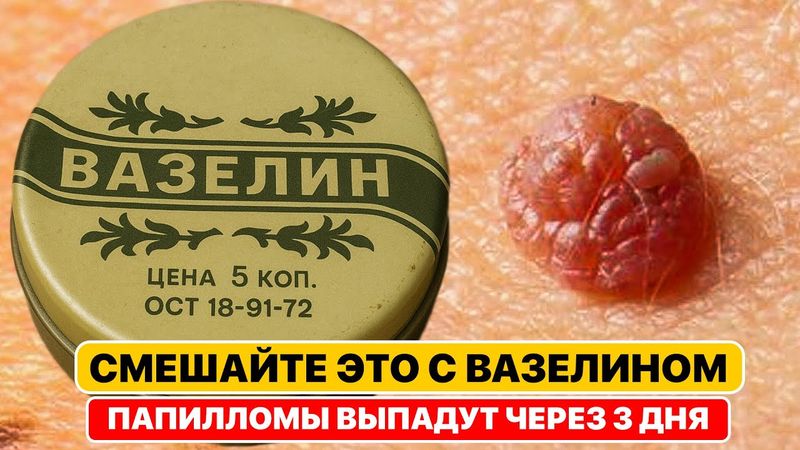 Папилломы, бородавки высохнут и отпадут сами! Нужно всего лишь добавить в вазелин одну вещь