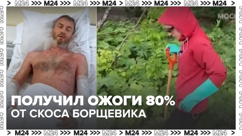 Россиянин получил ожоги 80% тела после того, как скосил борщевик! 🌱🔥