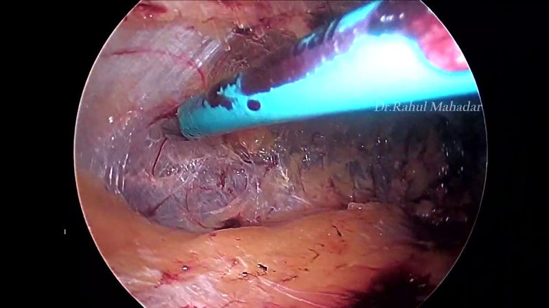 Left indirect inguinal hernia - eTEP repair