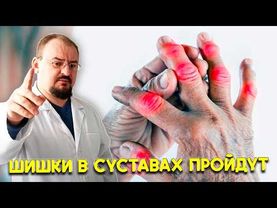 Реально рабочий метод удалить костные наросты на суставах дома🔥