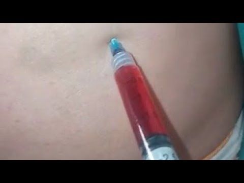 حقنة عضل جديدة | اخف ابرة فى العضل | تزريق الابرة للست| اسهل حقنة للسيدة