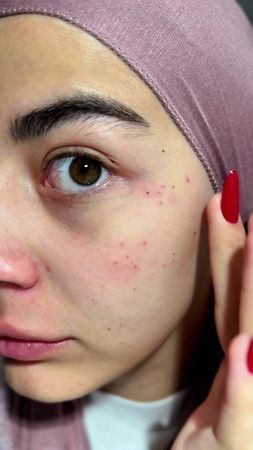 Моя кожа неидеальна. Акне, комедоны, чувствительность, покраснения и ...