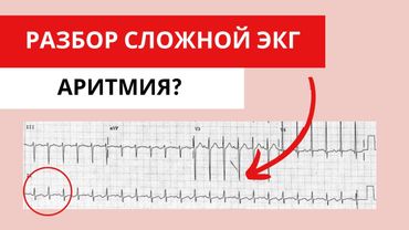 Разбор сложной ЭКГ. Аритмия или экстрасистолия?