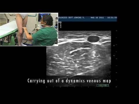 Perthes maneuver  predictive  of CHIVA result