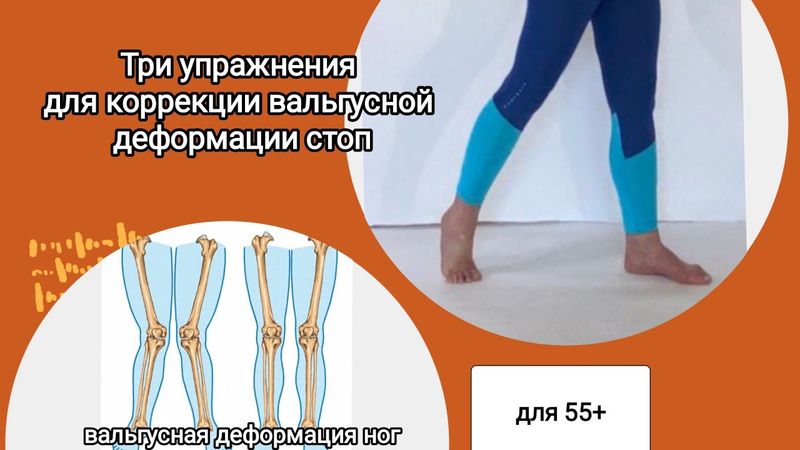 Три упражнения для коррекции вальгусной деформации стоп