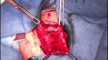 Rivisitazione della tecnica di Barcellona per la chiusura dell'ileostomia ad ansa