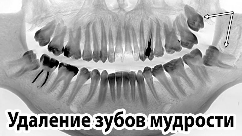 Разбор операции: удаление двух ретенированных зубов мудрости 28 и 38 (ретенция, дистопия)