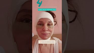 😱КАК МЕНЯЕТСЯ ЛИЦО после подтяжки за 14 дн?👆🏻#пластическийхирург #подтяжкалица #бьюти #косметолог