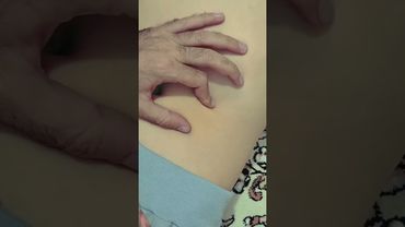 تزریق انسولین اطراف ناف (زیرجلدی دور ناف) #پرستاری #زیرجلدی #تزریقات