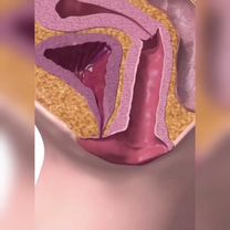 Лазерный лифтинг. Тюмень. Венец Афродиты. #Лифтингвлагалища #лазер