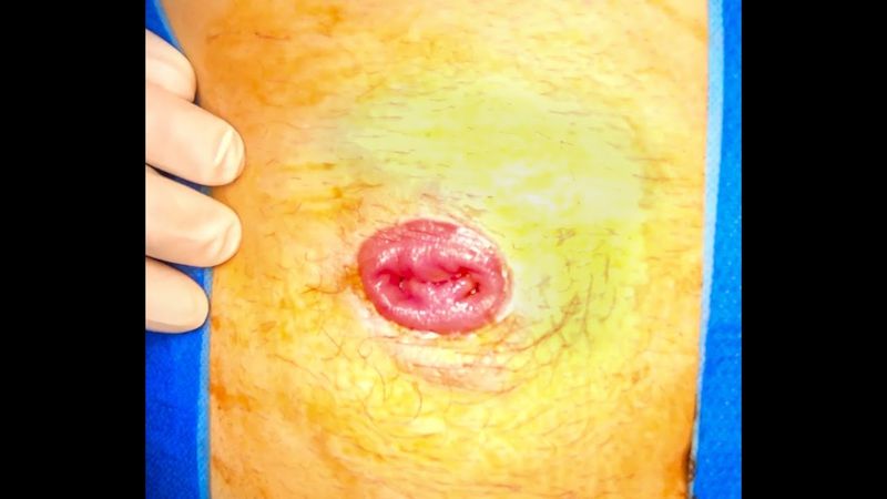 Closure of Transverse Loop Colostomy