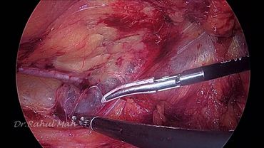 e-TEP RS with midline crossover at Hypogastrium