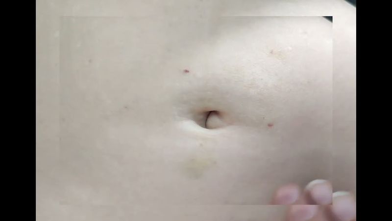 آمپولِ نافی Wow 😱😱💉#injection #تزریقات #تکنیک #آموزش #دانشجویی