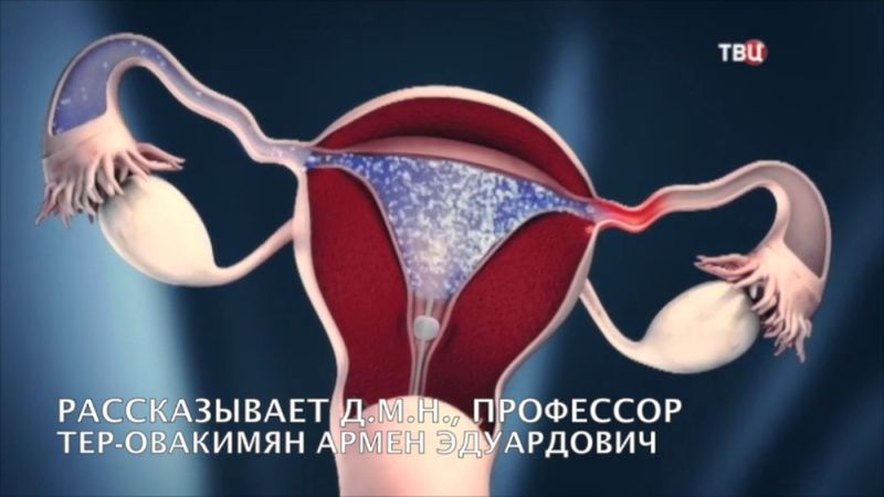 Доктор И (ТВЦ): Бесплодие, этапы (алгоритм) обследования