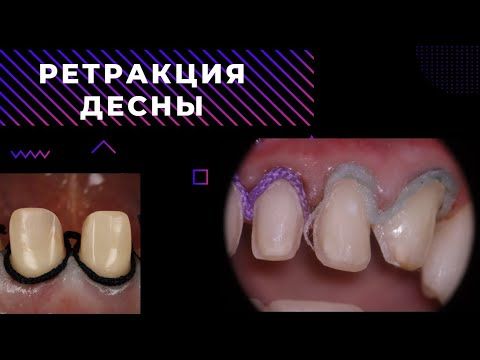 РЕТРАКЦИЯ ДЕСНЫ ДЛЯ НОВИЧКА