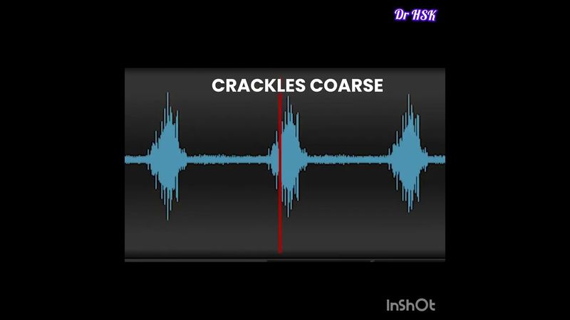 Breath Sounds/ Lung Sounds(Normal and Abnormal)