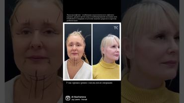 Эндосмаслифтинг: Идеальный подтягивающий эффект