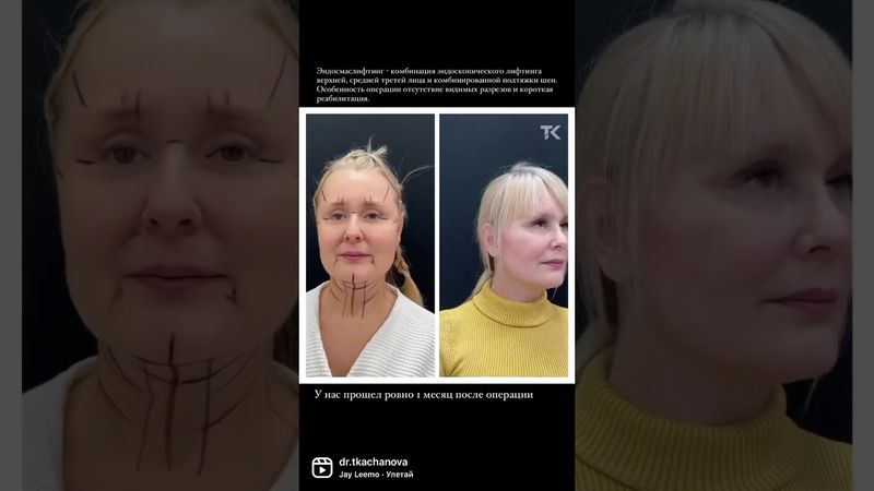 Эндосмаслифтинг: Идеальный подтягивающий эффект
