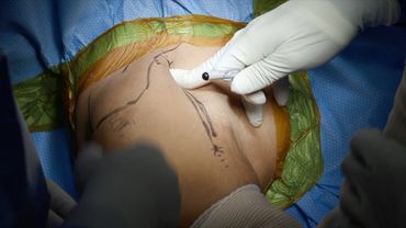 Reverse Total Shoulder Arthroplasty: Treatment of Chronic Anterior Glenohumeral Dislocation