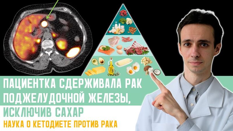 Реальный случай: как одна пациентка использовала кето-диету против рака поджелудочной железы
