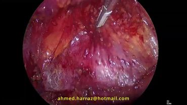 Retroperitoneal laparoscopic pyeloplasty (Right)