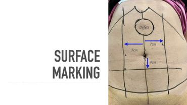eTEP RS with midline crossover in hypogastrium for Primary Epigastric Hernia with divarication