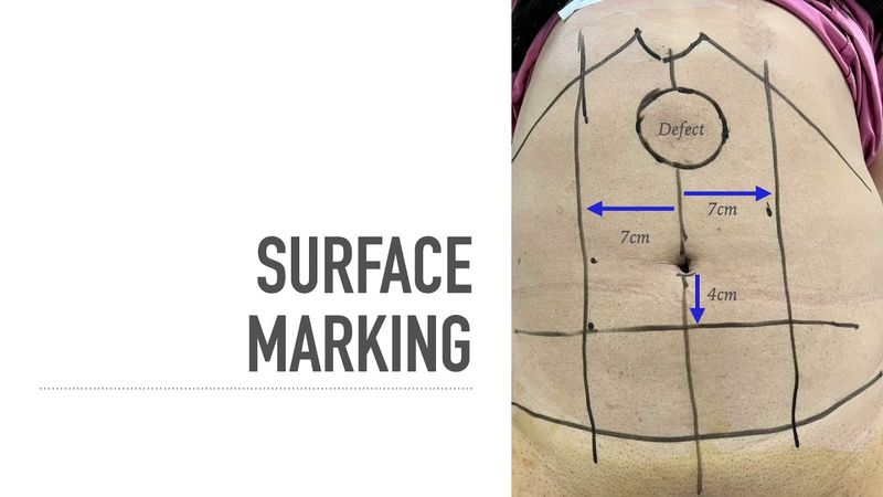 eTEP RS with midline crossover in hypogastrium for Primary Epigastric Hernia with divarication