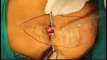 Peritoneal Flap Hernioplasty combined with ACST/External Oblique Release for Large Ventral Hernia