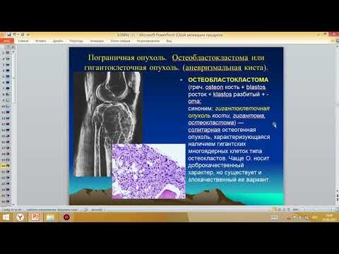 Опухоли костей и суставов