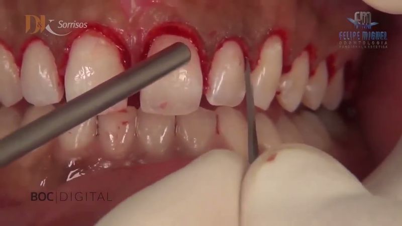 Гингивэктомия 🦷🦷