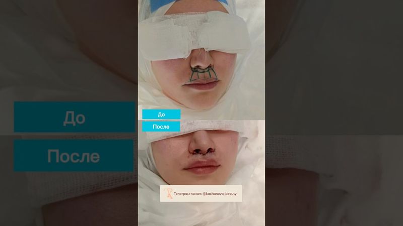 😍Операция, которую я рекомендую практически всем👆🏻ДО/ПОСЛЕ #пластическийхирург #подтяжкалица #рек