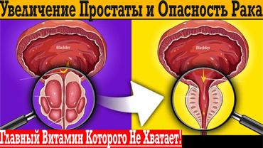 Здоровая ПРОСТАТА! Увеличение предстательной железы и опасность РАКА!