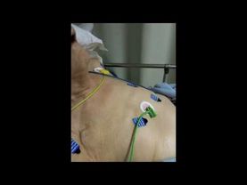 Dyspnée de Cheyne-Stockes