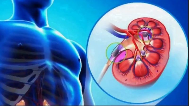 LR  Камни в почках, кальцинозы сосудов и тканей -  убрать и предупредить