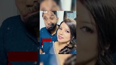 "Мене не обслужили в кафе через понівечене обличчя". Історія Аміта Госе. #shorts #здоровя #добро