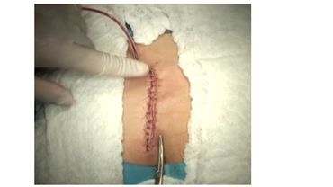 Karydakis Technique for the Treatment of Pilonidal Disease